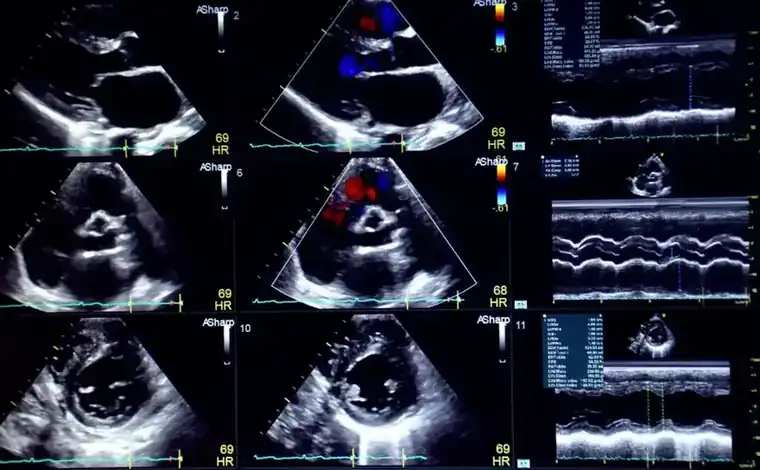 Let Hollywood Diagnosticss Handle Your EKG & Echocardiogram Testing
