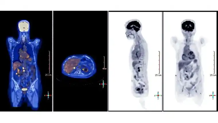 What Should You Expect When Getting a PET Scan?
