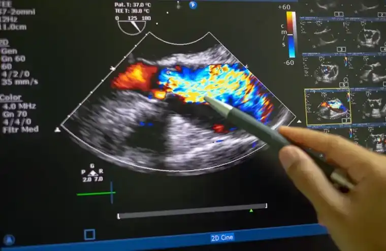 FDA Clears Echocardiography AI to Aid in Fight Against Coronary Artery Disease