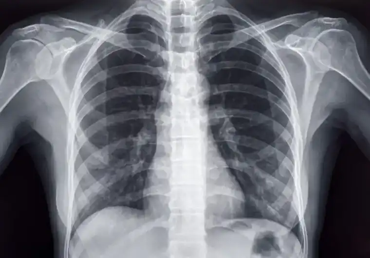 No More Lead Aprons During X-Rays?