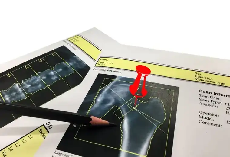 Top Reasons Why You Could Need a Bone Density Scan