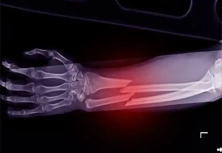 Assessing the Damage of a Broken Bone