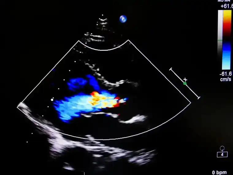 Echocardiogram Versus Ultrasound