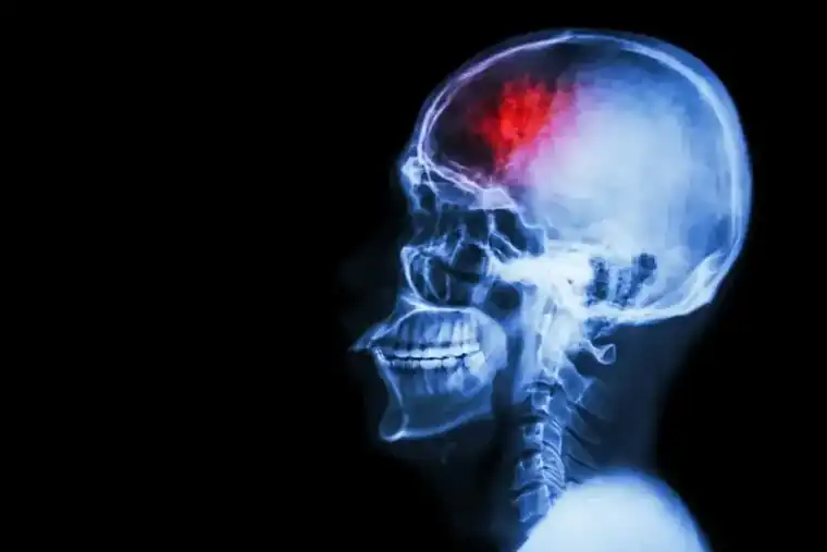 Head Trauma Can Leave Hidden Surprises