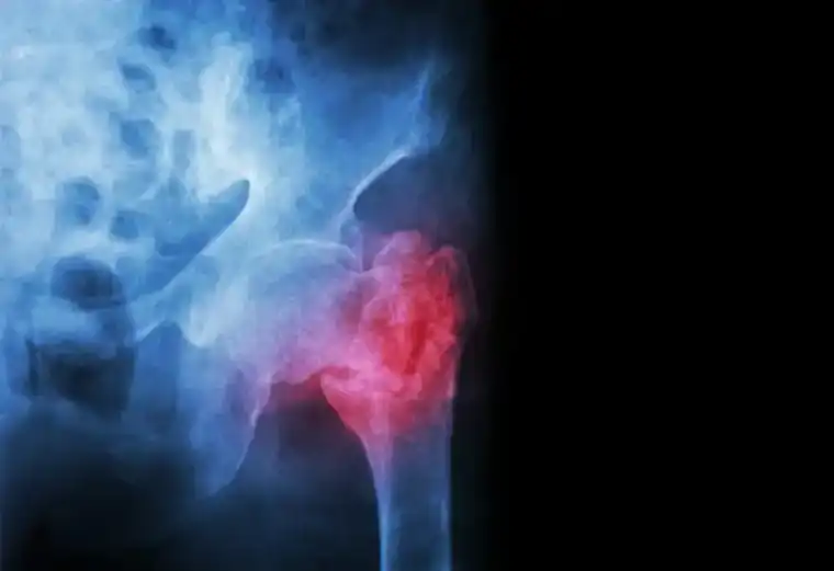 How Long Does a Bone Fracture Take to Heal?