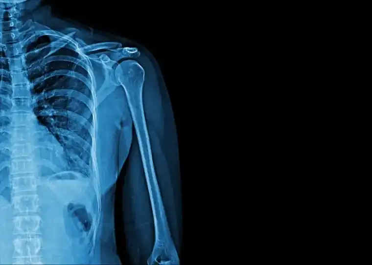Why You Should Always Get X-rays After a Bone Injury