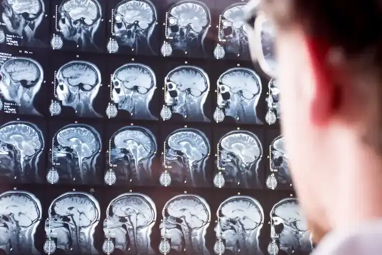 MRI scan, Hollywood Diagnostics